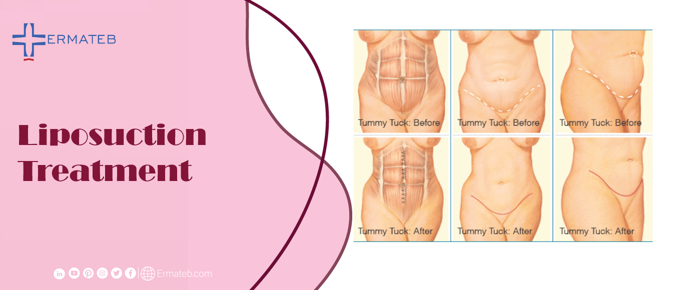 body Liposuction